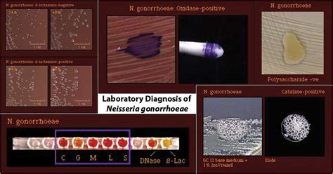 5. Laboratory diagnosis of gonorrhoea (Neisseria .